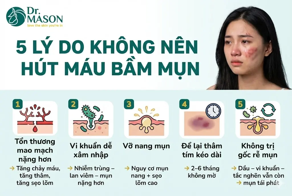 5 lý do không nên hút máu bầm