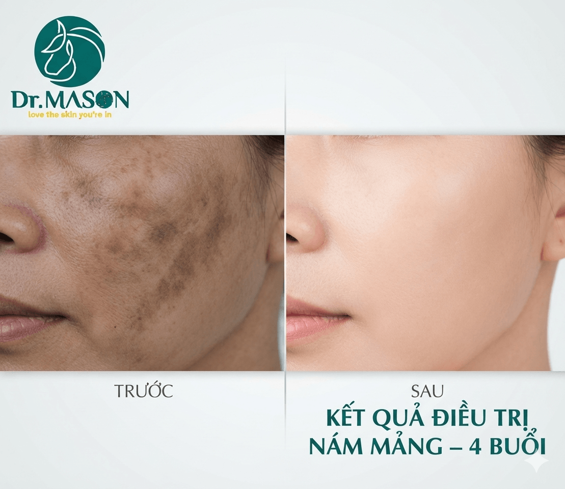 Kết quả điều trị nám mảng sau 4 buổi