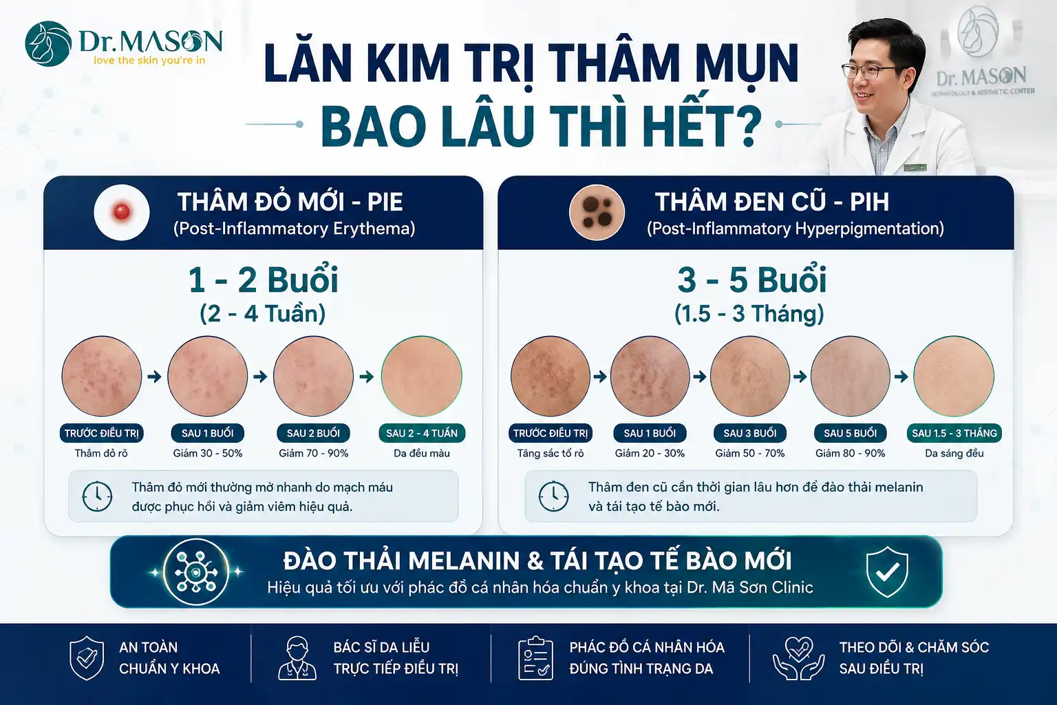 Lăn kim trị thâm mụn bao lâu thì hết