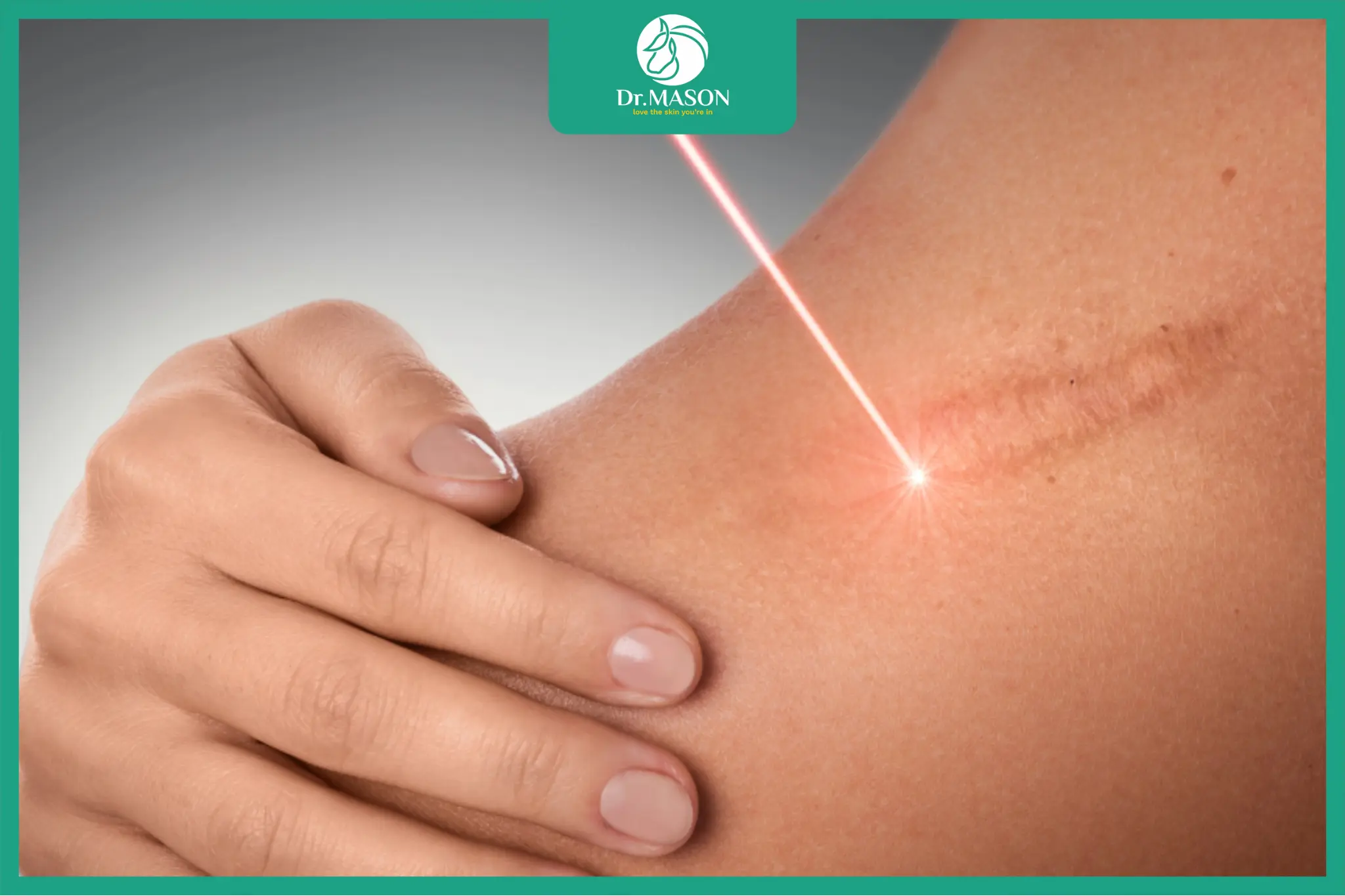 Ứng dụng laser trong phác đồ điều trị sẹo lồi tại phòng khám Dr. Mã Sơn giúp giảm đỏ và cải thiện bề mặt da