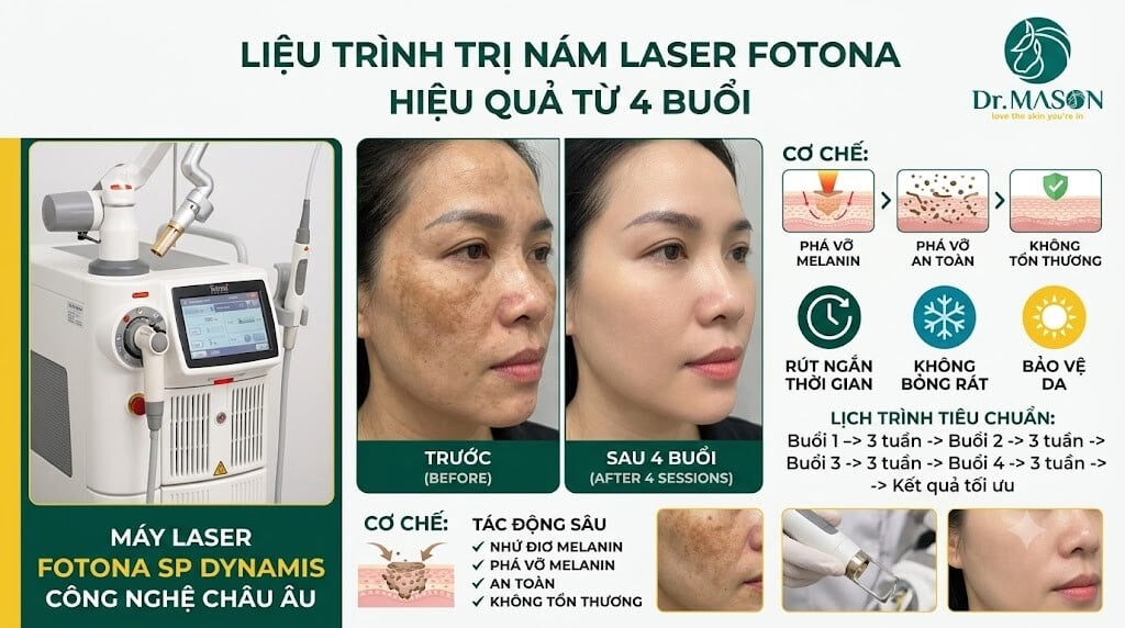 Liệu trình Laser Fotona trị nám