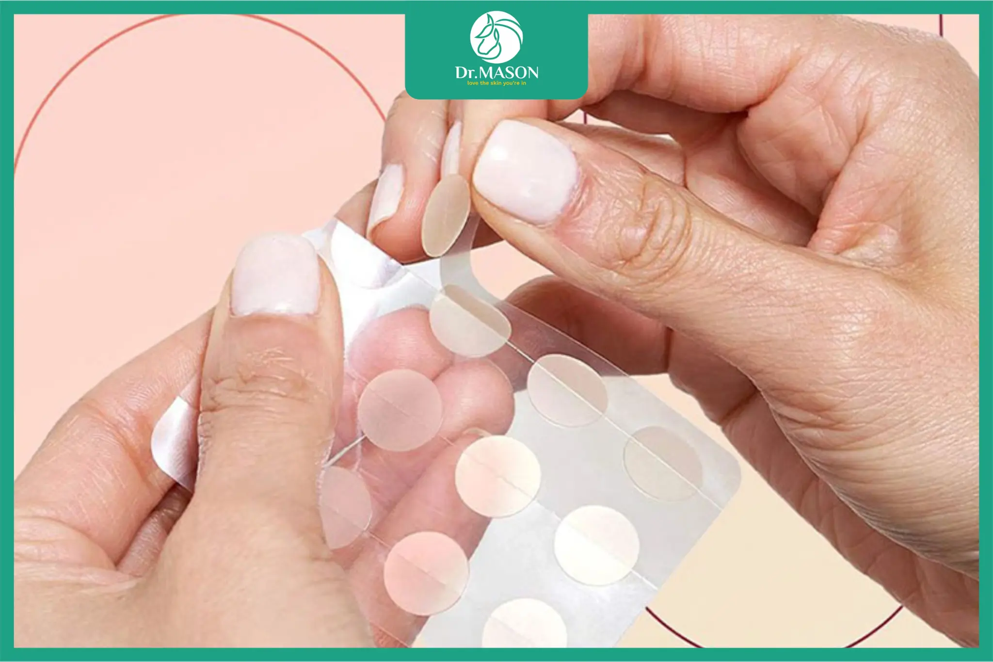 Miếng dán mụn microneedle sử dụng công nghệ vi kim thế hệ mới để hỗ trợ điều trị mụn tại chỗ