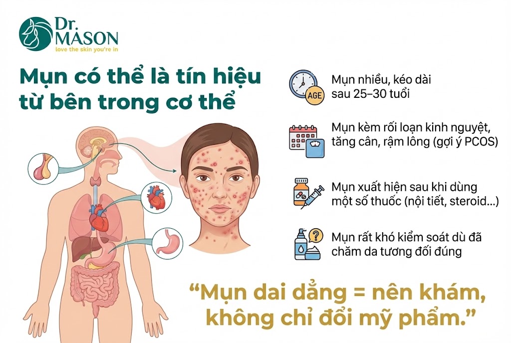 mụn có thể là tìn hiệu từ bên trong cơ thể