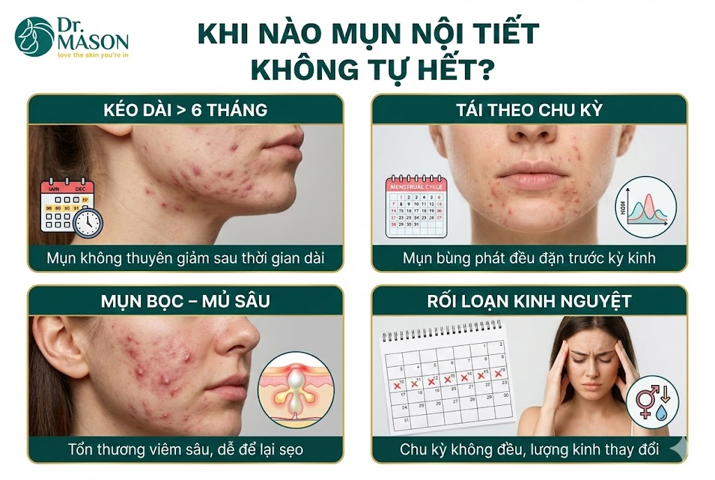 khi nào mụn nội tiết không tự hết