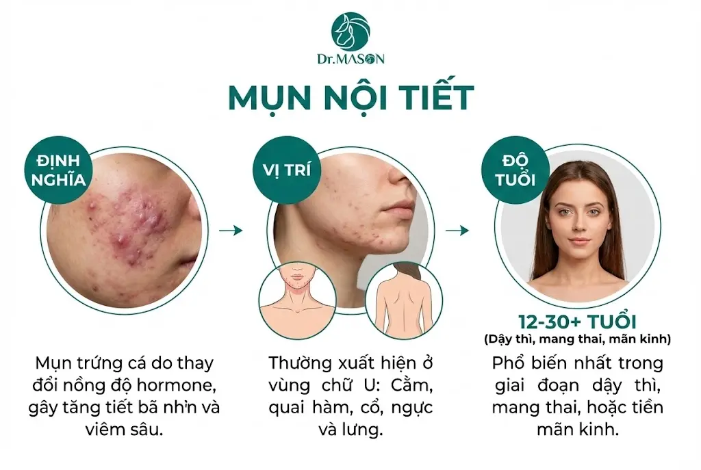 mụn nội tiết