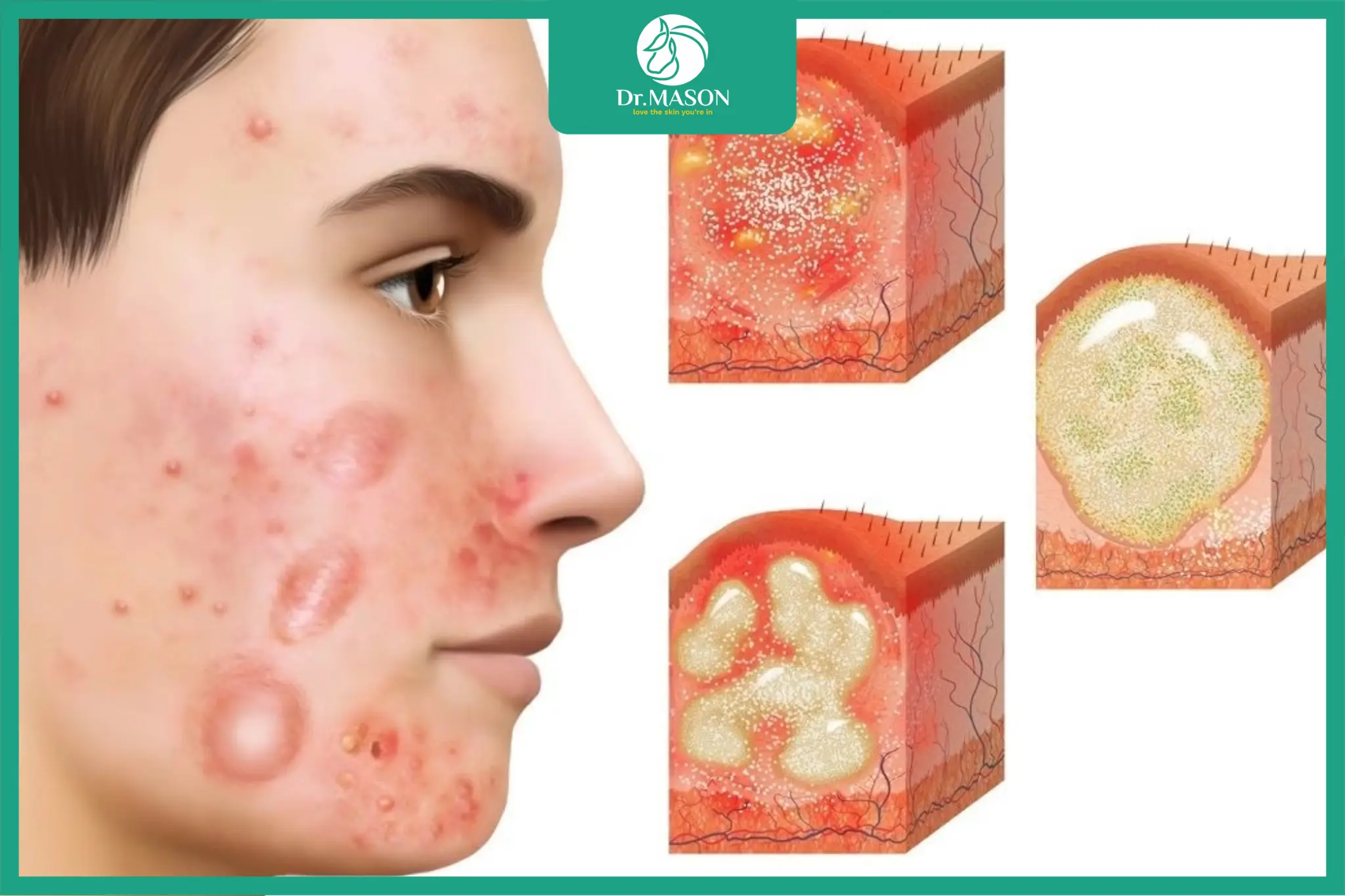 Cận cảnh mụn viêm sưng đỏ và có mủ trên da mặt, dễ để lại thâm sẹo nếu xử lý sai cách