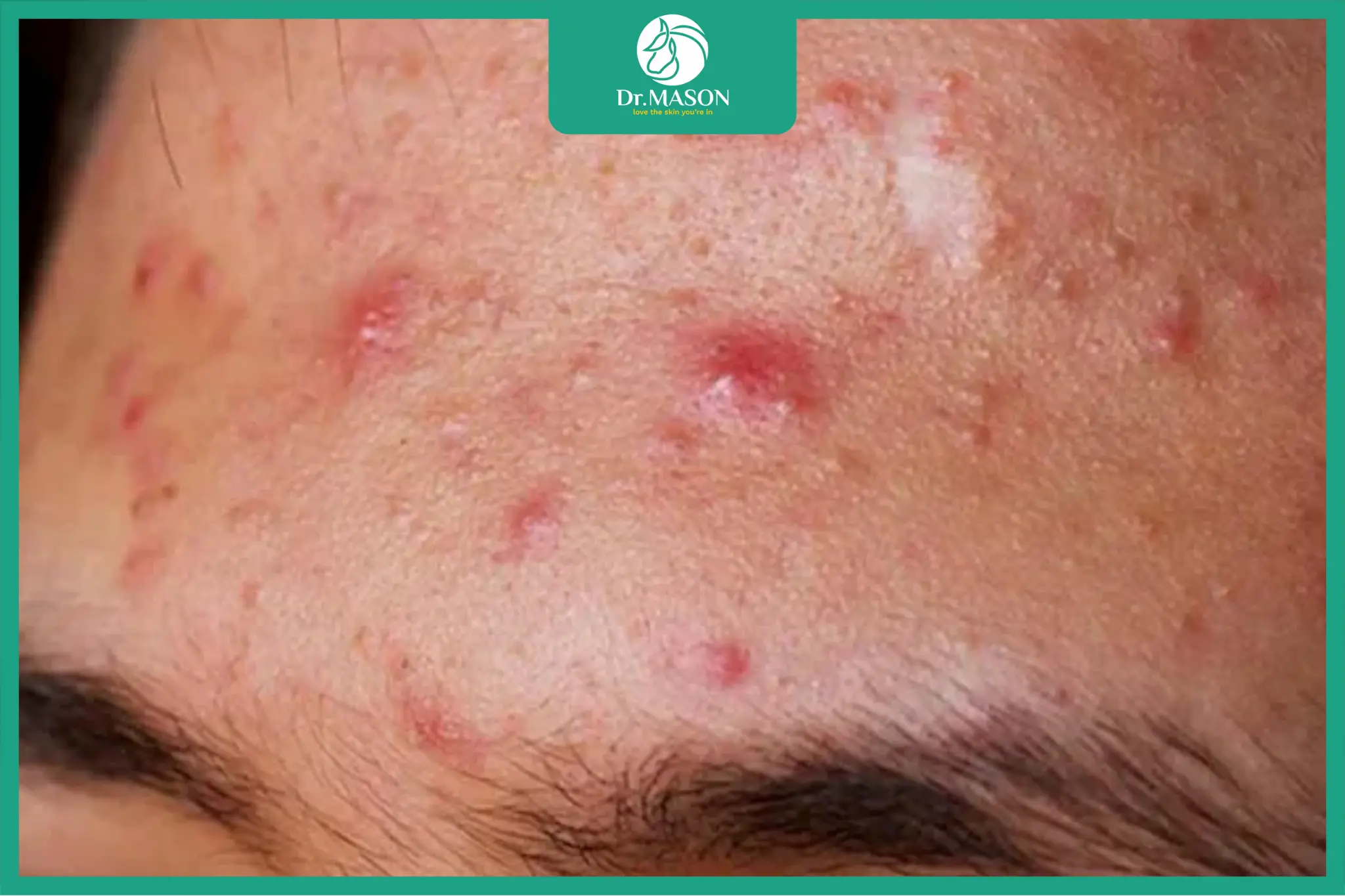 hình ảnh mụn viêm nhiễm trùng vùng trán