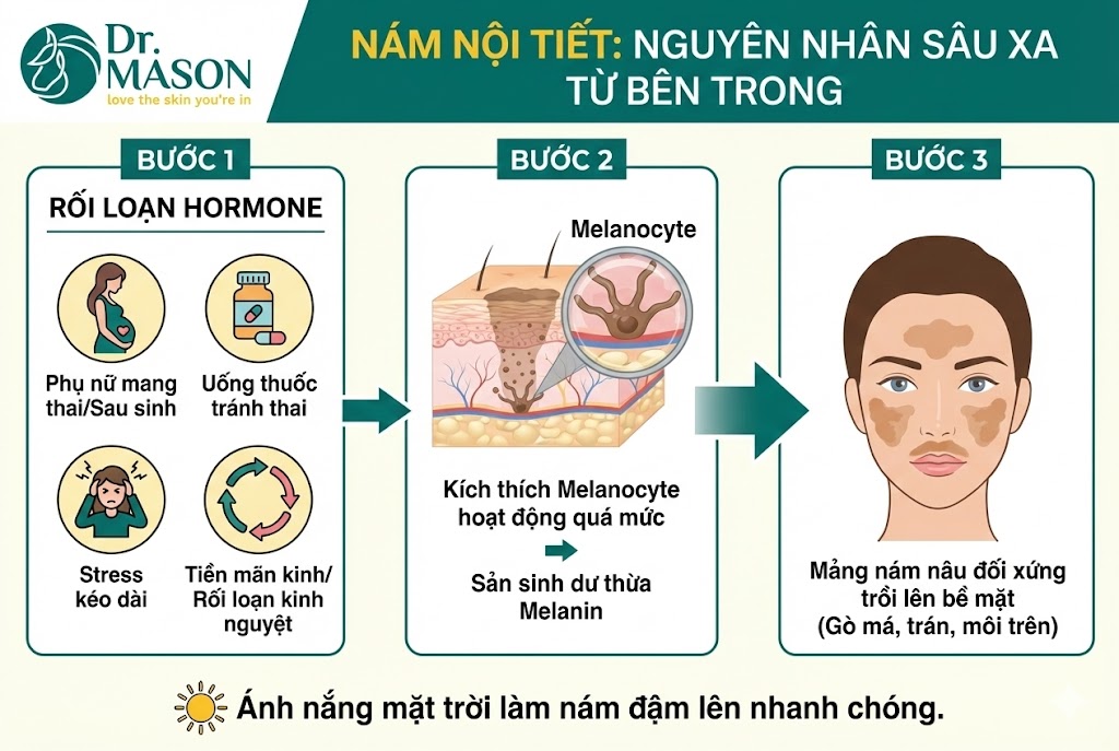 nguyên nhân từ trong ra ngoài của nám nội tiết