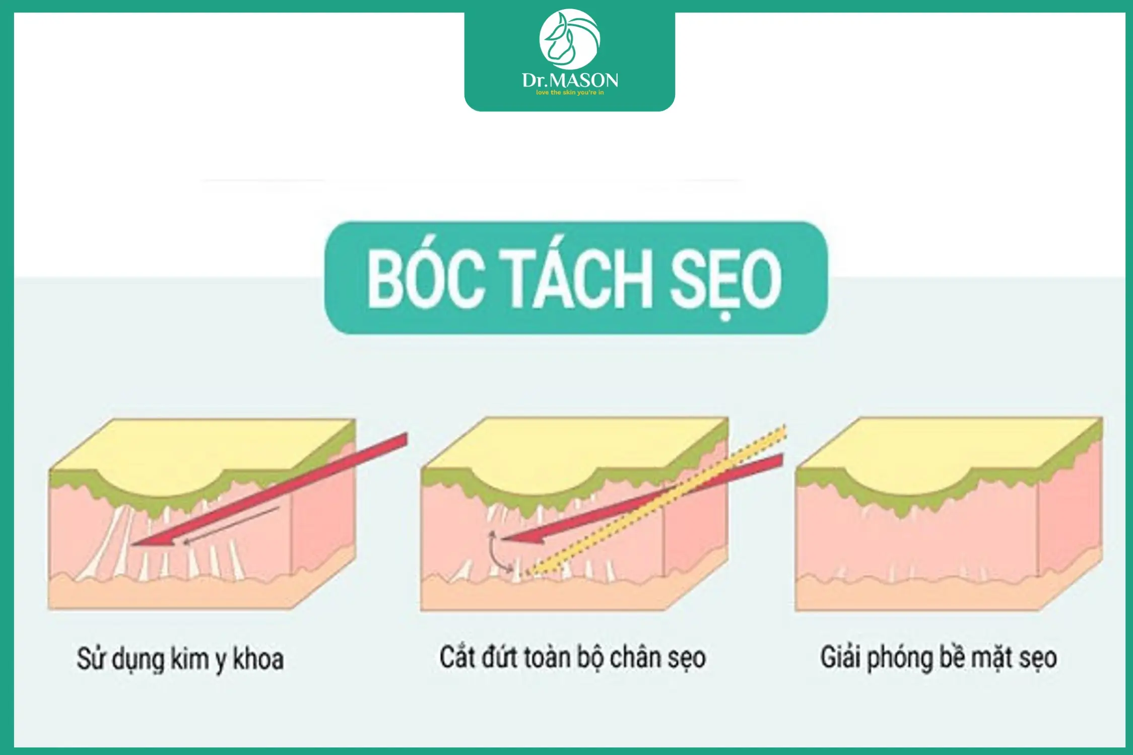 hình ảnh nguyên lý bóc tách đáy sẹo