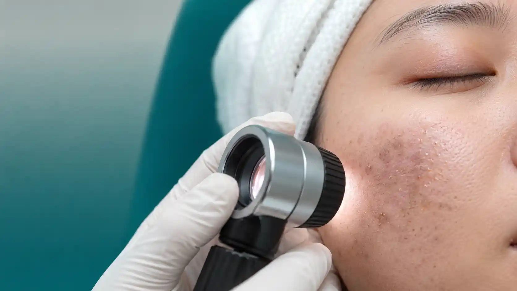 Phân biệt da bị thâm sau khi bắn laser và tăng sắc tố PIH
