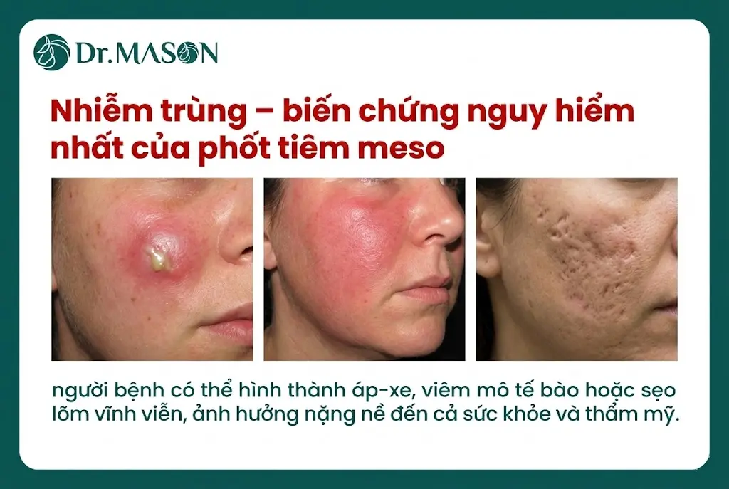 biến chứng nguy hiểm của tiêm meso gặp ở phốt