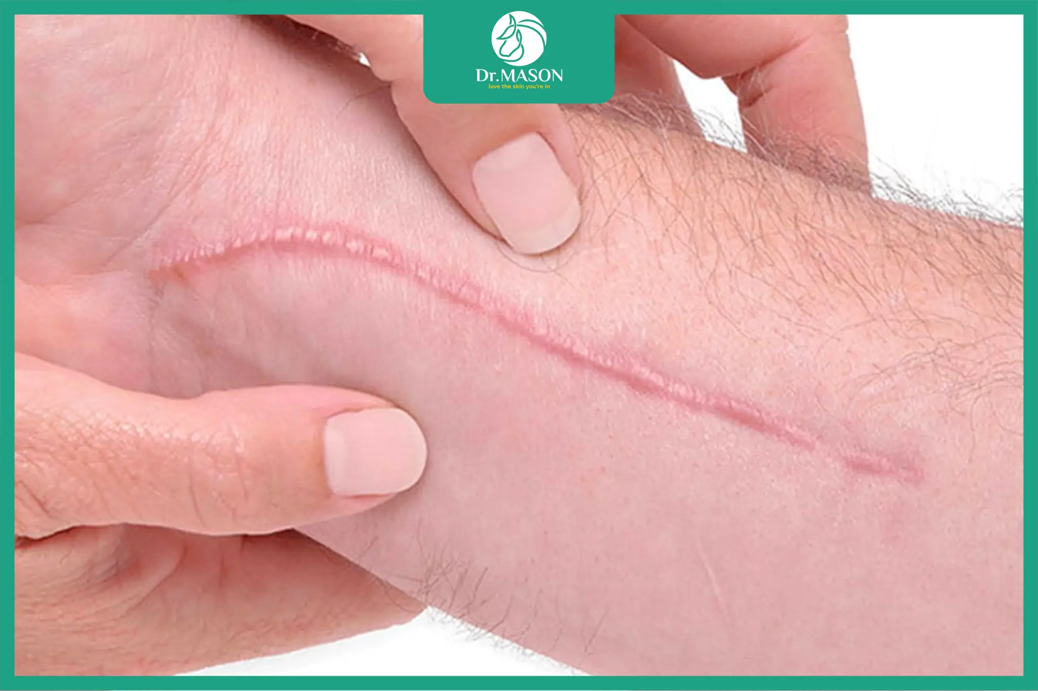 Sẹo lồi gồ cao và đỏ trên da sau chấn thương hoặc phẫu thuật khiến bề mặt da không phẳng