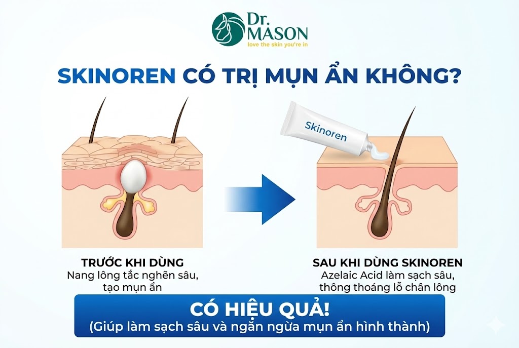 skinoren có trị mụn ẩn không