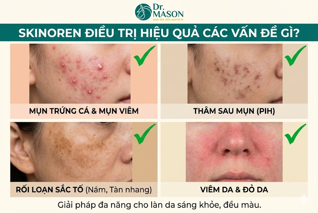 skinoren giải quyết các vấn đề