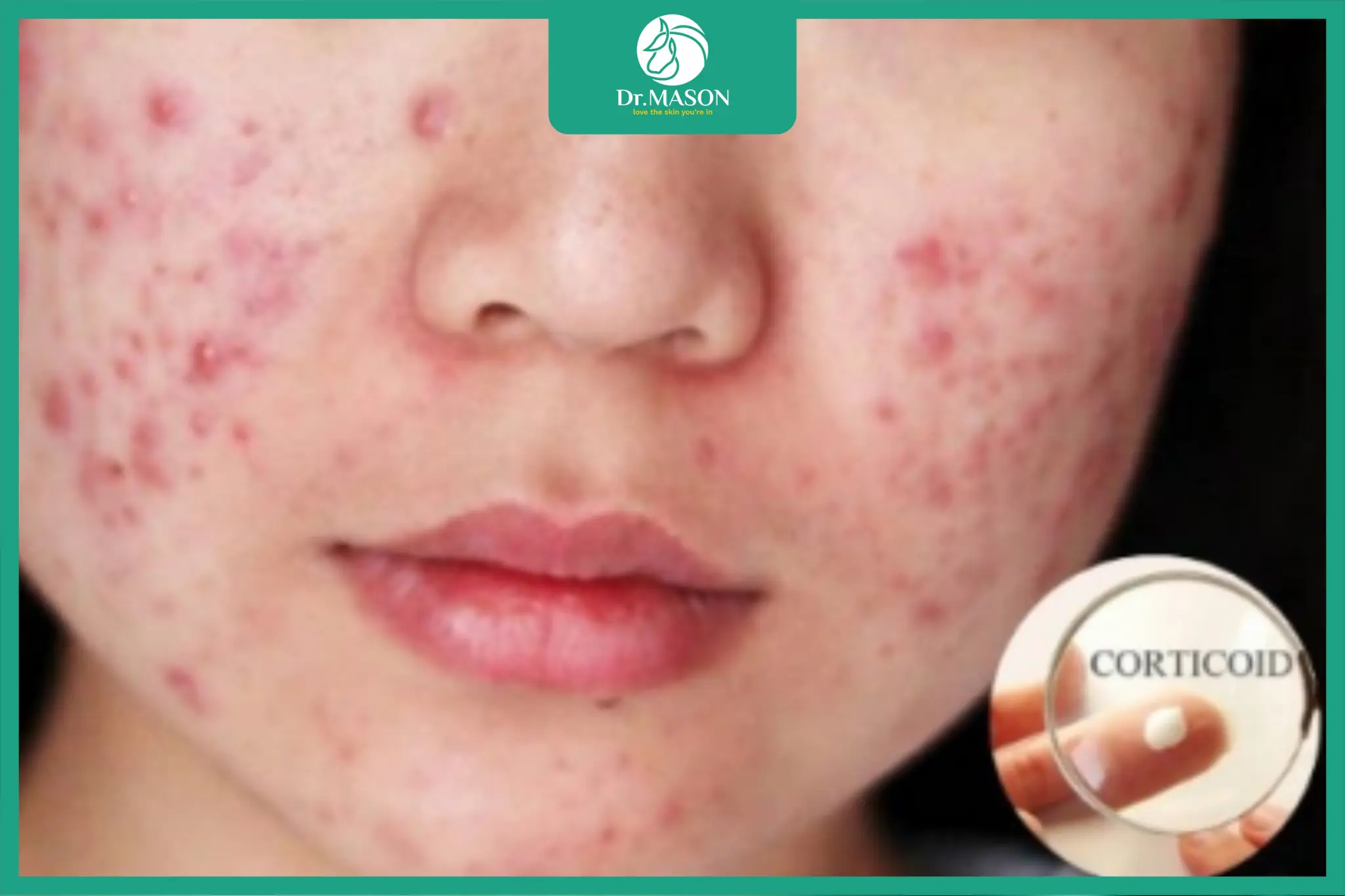 tác hại của việc sử dụng kem trộn