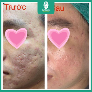 Cảm nhận khách hàng sau 1 buổi điều trị sẹo mụn