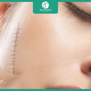 Sẹo lồi: Nguyên nhân, dấu hiệu và cách điều trị
