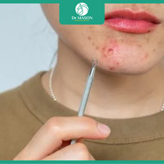 Mụn viêm là gì? Hướng dẫn xử lý đúng cách ngăn ngừa sẹo