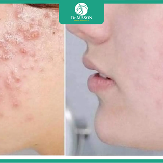Hành trình phục hồi da nhiễm corticoid thành công tại Dr. Mã Sơn