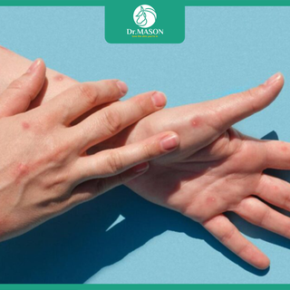 Thủy đậu lây như thế nào? Cách phòng tránh hiệu quả cho cả gia đình