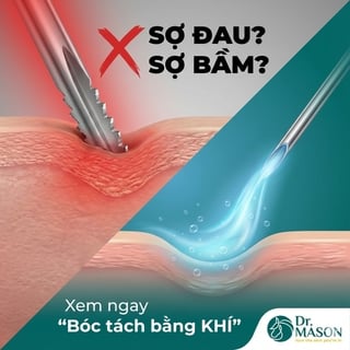 Bóc tách đáy sẹo bằng khí (Cập nhật ngày 16/07/2026)