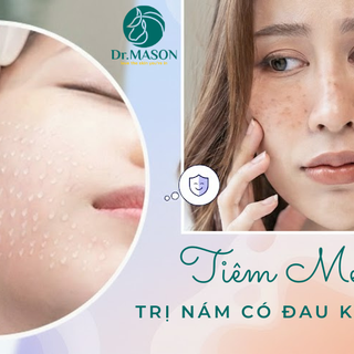 Hiệu quả của tiêm Meso trị nám da