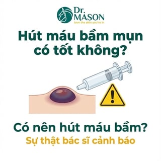Hút máu bầm mụn có tốt không? Sự thật cần biết trước khi làm!