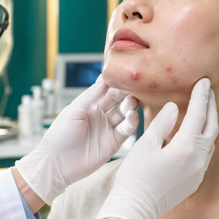 Khám Mụn Nội Tiết Uy Tín Tại TP.HCM