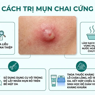 Mụn bị chai cứng phải làm sao? Hiểu đúng để xử lý an toàn và hiệu quả