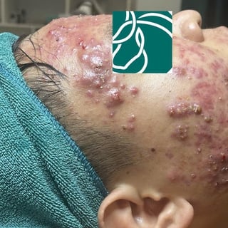 Cấp Cứu Làn Da Biến Dạng Vì Mụn U Nang Kháng Thuốc: Liệu Phép Màu Có Có Thật?