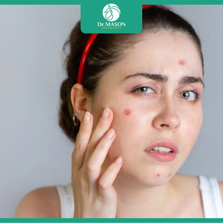 Mụn trứng cá: Nguyên nhân và hướng điều trị