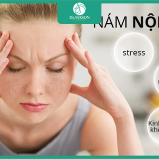 Nguyên nhân nám nội tiết khó trị dứt điểm
