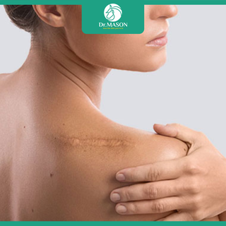 Các phương pháp điều trị sẹo lồi an toàn