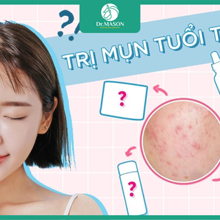 Điều trị mụn cho học sinh, sinh viên: Khi nào nên đi khám?