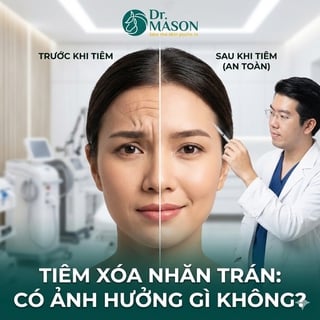 Tiêm xóa nhăn trán có an toàn không?
