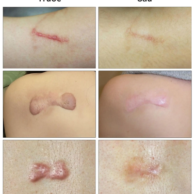 Bảng giá tiêm trị sẹo lồi