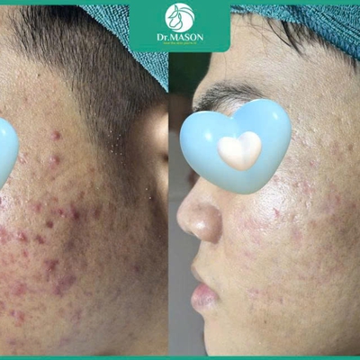 Bảng giá trị mụn bằng IPL