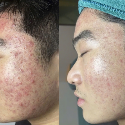 Bảng giá trị mụn bằng IPL