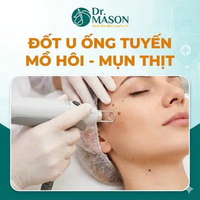 Đốt u ống tuyến mồ hôi - mụn thịt