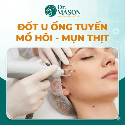 Đốt u ống tuyến mồ hôi - mụn thịt