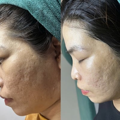 Bảng giá chấm TCA trị sẹo rỗ 