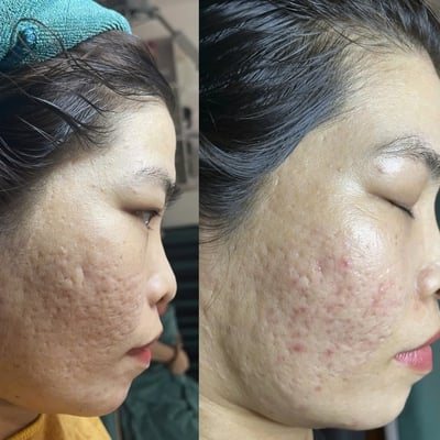 Bảng giá chấm TCA trị sẹo rỗ 