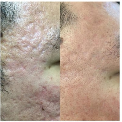 Lăn Kim trị sẹo