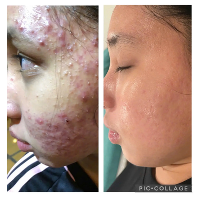 Bảng giá trị mụn bằng IPL