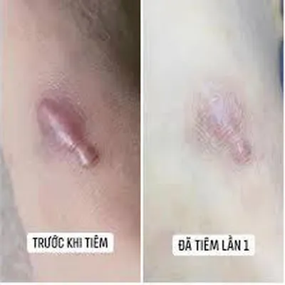 Tiêm trị sẹo lồi giá bao nhiêu? Bảng giá