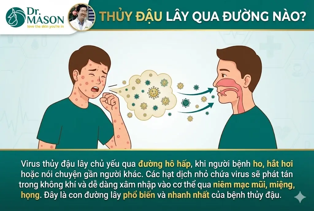 Thủy đậu lây qua đường nào