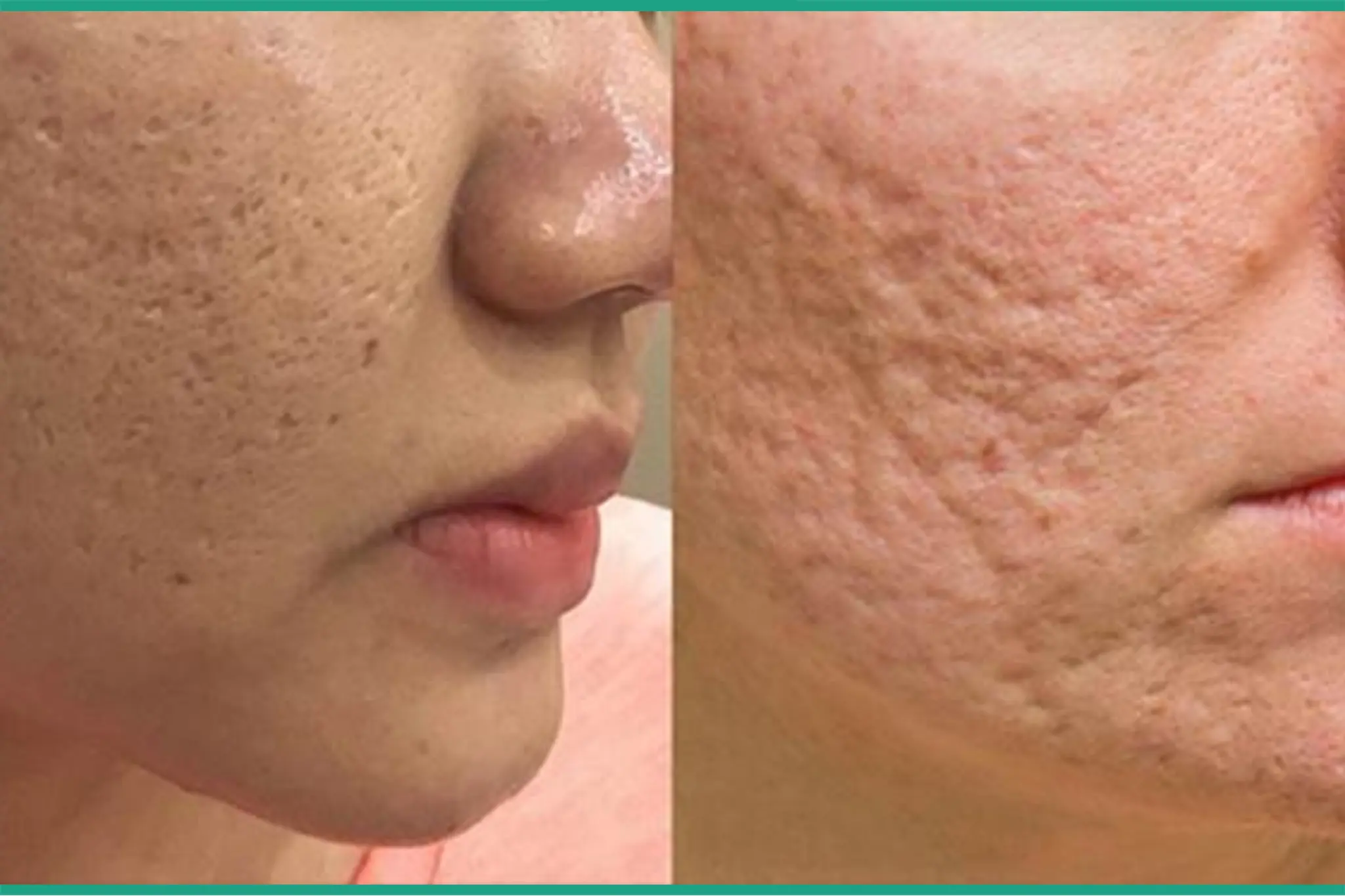 trái sẹo đáy nhọn, phải sẹo lõm phức tạp