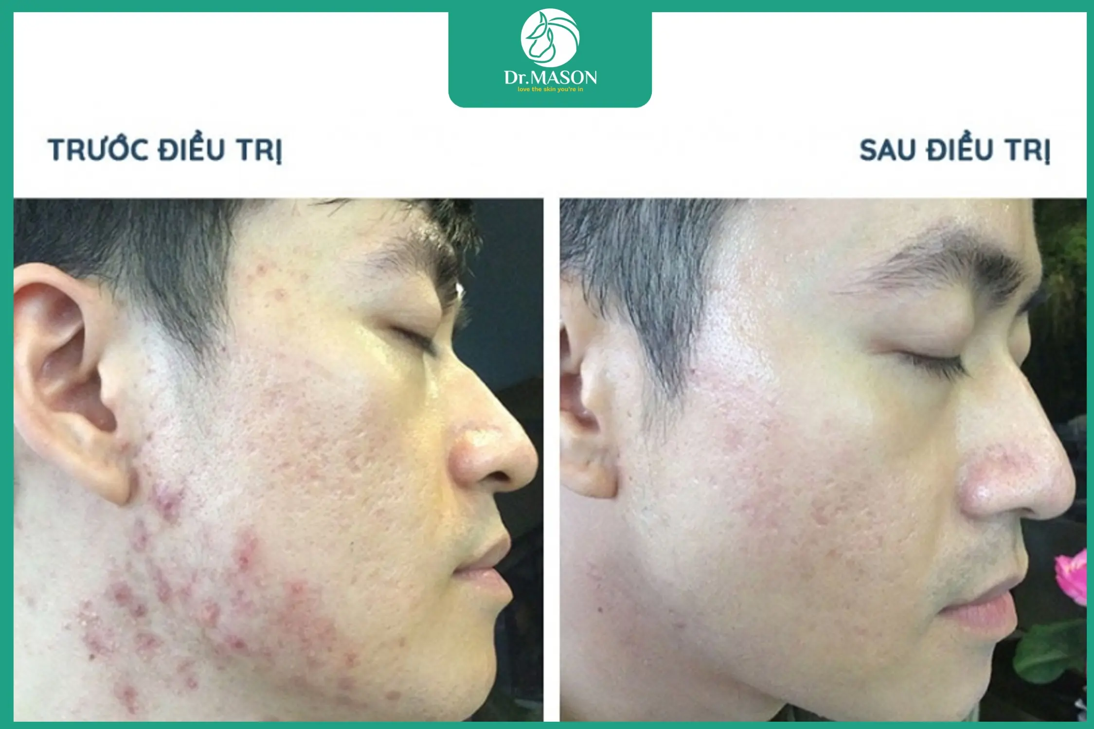 trước và sau khi điều trị sẹo kèm mụn viêm