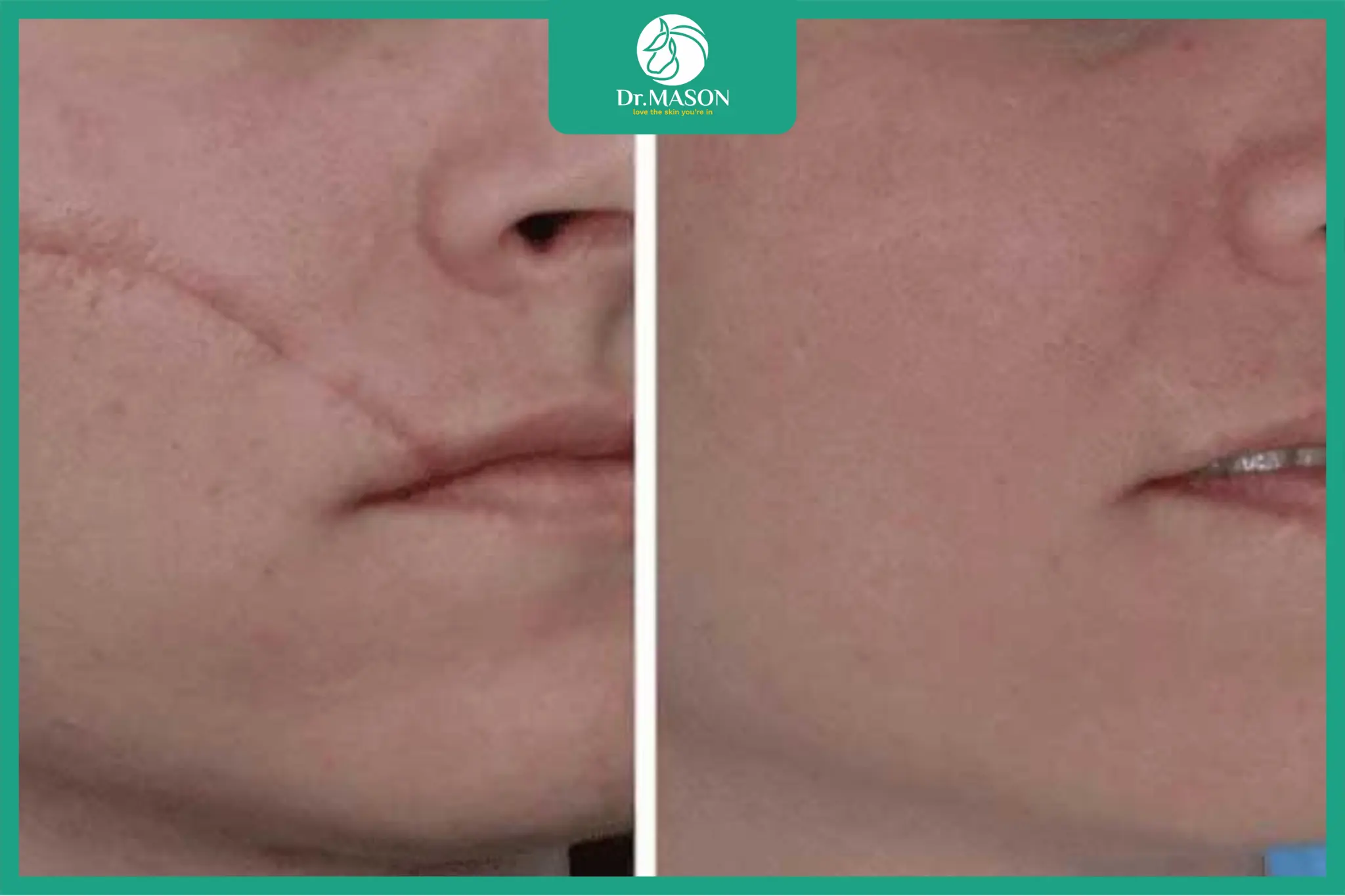 Hình ảnh so sánh trước và sau điều trị sẹo lồi tại Dr. Mã Sơn cho thấy sẹo bớt đỏ và phẳng hơn