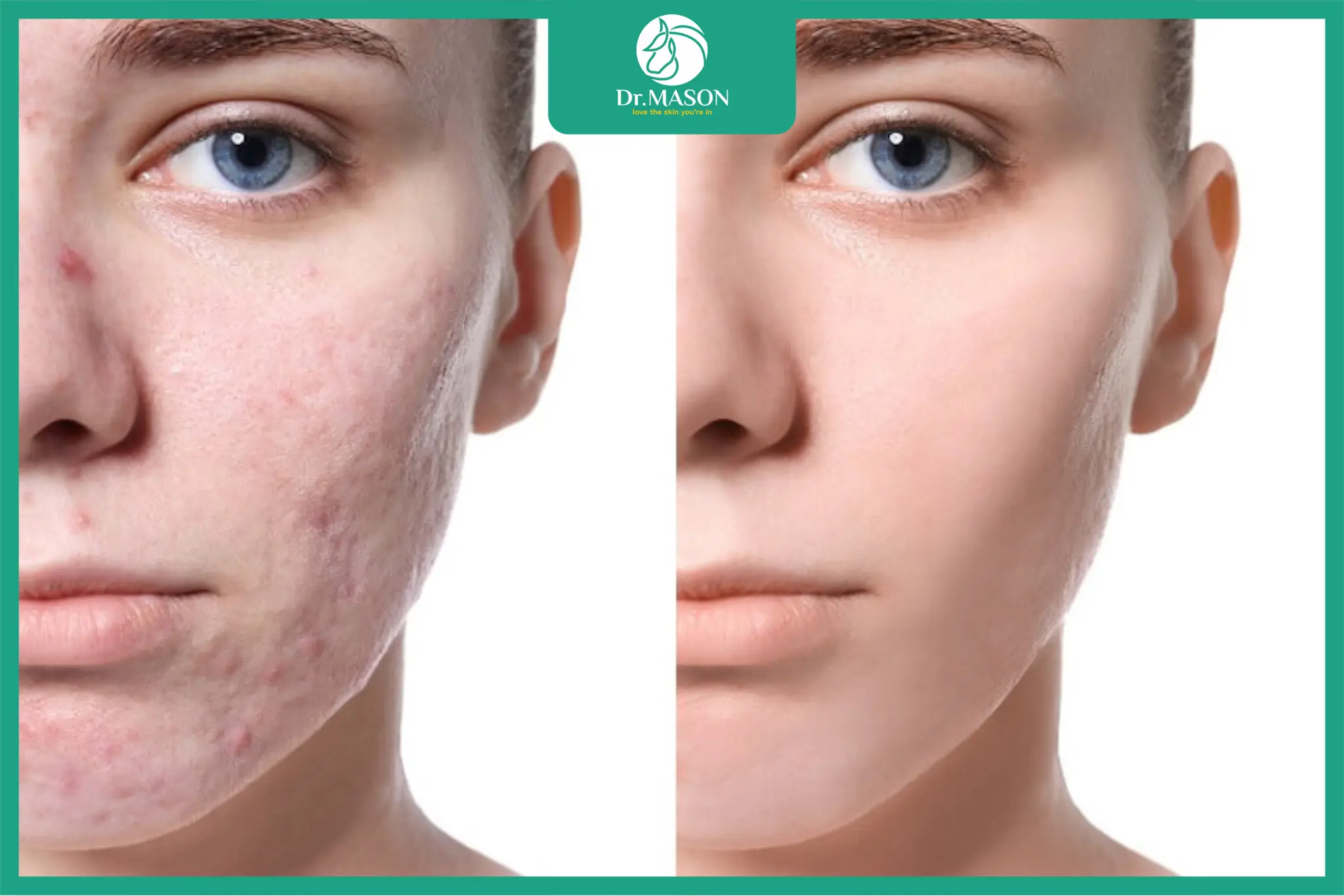 Hình ảnh trước và sau điều trị sẹo rỗ bằng lăn kim và laser